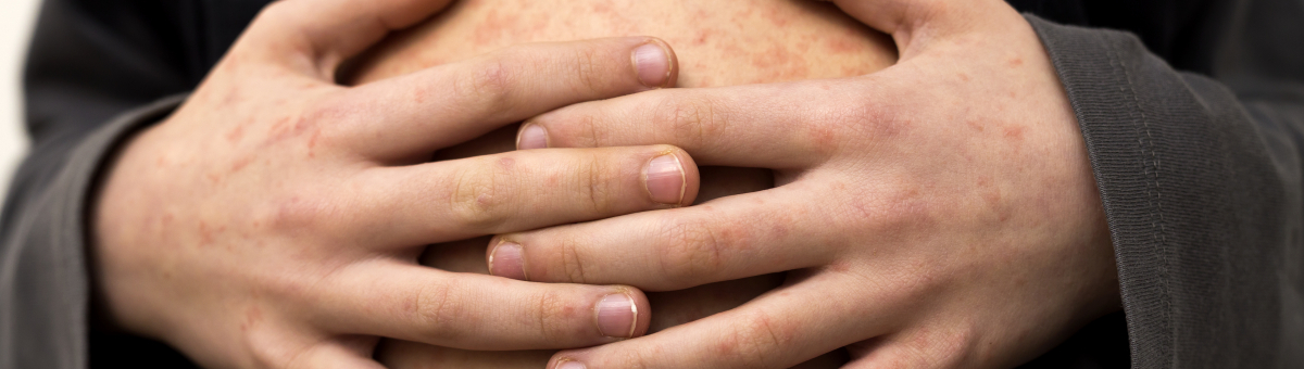 A child with measles rash on hands and torso